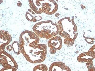 Immunohistochemistry-Paraffin: Cytokeratin 18 Antibody (DE-K18) - IHC-Prediluted [NBP2-48055] - Human Colon Carcinoma stained with Cytokeratin 18 Monoclonal Antibody (DE-K18).