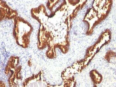 Immunohistochemistry-Paraffin: Cytokeratin 18 Antibody (KRT18/1190) - Azide and BSA Free [NBP2-47984] - Human Prostate Carcinoma stained with Cytokeratin 18 Mouse Monoclonal Antibody (KRT18/1190).