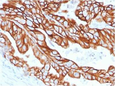 Immunohistochemistry-Paraffin: Cytokeratin 18 Antibody (KRT18/2808R) - Azide and BSA Free [NBP3-08634] - Formalin-fixed, paraffin-embedded human Colon Carcinoma stained with Cytokeratin 18 Rabbit Recombinant Monoclonal Antibody (KRT18/2808R).