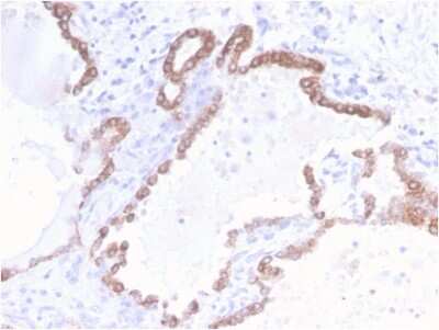 Immunohistochemistry-Paraffin: Cytokeratin 18 Antibody (KRT18/2808R) - Azide and BSA Free [NBP3-08634] - Formalin-fixed, paraffin-embedded human Colon Carcinoma stained with Cytokeratin 18 Rabbit Recombinant Monoclonal Antibody (KRT18/2808R).