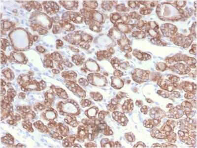 Immunohistochemistry-Paraffin: Cytokeratin 18 Antibody (KRT18/2808R) [NBP3-07692] - Formalin-fixed, paraffin-embedded human Thyroid Carcinoma stained with Cytokeratin 18 Rabbit Recombinant Monoclonal Antibody (KRT18/2808R).