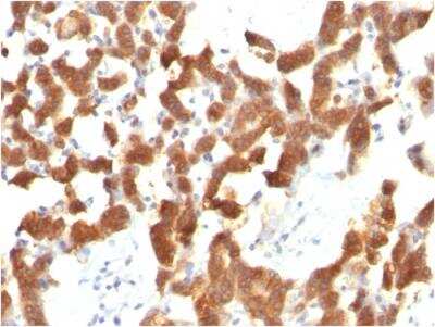 Immunohistochemistry-Paraffin: Cytokeratin 18 Antibody (KRT18/834) - Azide and BSA Free [NBP2-47985] - Human Thyroid Carcinoma stained with Cytokeratin 18 Mouse Monoclonal Antibody (KRT18/834).