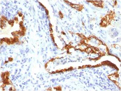 Immunohistochemistry-Paraffin: Cytokeratin 18 Antibody (KRT18/834) - Azide and BSA Free [NBP2-47985] - Human Lung Carcinoma stained with Cytokeratin 18 Mouse Monoclonal Antibody (KRT18/834).