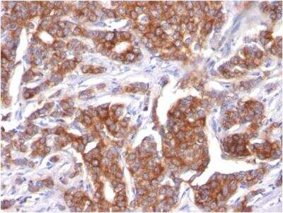 Immunohistochemistry-Paraffin: Cytokeratin 18 Antibody (KRT18/834) - Azide and BSA Free [NBP2-47985] - Human Breast Carcinoma stained with Cytokeratin 18 Mouse Monoclonal Antibody (KRT18/834).