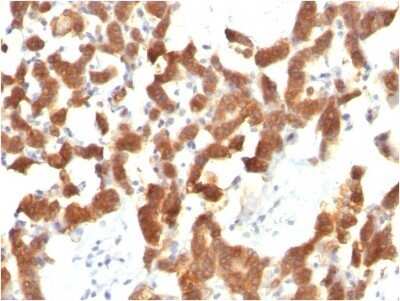 Immunohistochemistry-Paraffin: Cytokeratin 18 Antibody (KRT18/834) - IHC-Prediluted [NBP2-48056] - Formalin-fixed, paraffin-embedded human Thyroid Carcinoma stained with Cytokeratin 18 Antibody (KRT18/834).