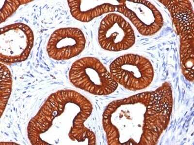 Immunohistochemistry-Paraffin: Cytokeratin 18 Antibody (KRT18/834) - IHC-Prediluted [NBP2-48056] - Human Colon Carcinoma stained with Cytokeratin 18 Monoclonal Antibody (KRT18/834).