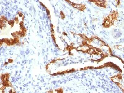 Immunohistochemistry-Paraffin: Cytokeratin 18 Antibody (KRT18/834) - IHC-Prediluted [NBP2-48056] - Human Lung Carcinoma stained with Cytokeratin 18 Monoclonal Antibody (KRT18/834).