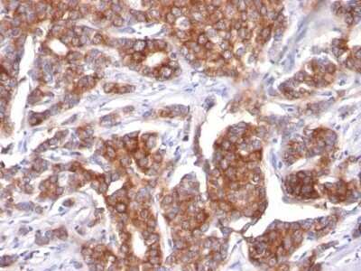 Immunohistochemistry-Paraffin: Cytokeratin 18 Antibody (KRT18/834) - IHC-Prediluted [NBP2-48056] - Human Breast Carcinoma stained with Cytokeratin 18 Monoclonal Antibody (KRT18/834).