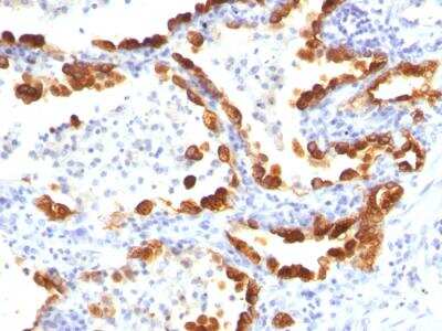 Immunohistochemistry-Paraffin: Cytokeratin 18 Antibody (KRT18/835) - Azide and BSA Free [NBP2-47986] - Formalin-fixed, paraffin-embedded human Lung Cancer stained with Cytokeratin 18 Mouse Monoclonal Antibody (KRT18/835).