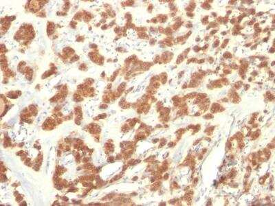Immunohistochemistry-Paraffin: Cytokeratin 18 Antibody (KRT18/835) - Azide and BSA Free [NBP2-47986] - Formalin-fixed, paraffin-embedded human Thyroid Cancer stained with Cytokeratin 18 Mouse Monoclonal Antibody (KRT18/835).