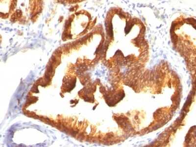 Immunohistochemistry-Paraffin: Cytokeratin 18 Antibody (KRT18/836) [NBP2-44950] - Human Prostate Carcinoma stained with Cytokeratin 18 Monoclonal Antibody (KRT18/836).