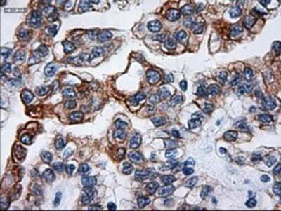 Immunohistochemistry: Cytokeratin 18 Antibody (OTI1E1) - Azide and BSA Free [NBP2-71086] - Staining of paraffin-embedded Carcinoma of Human kidney tissue using anti-KRT18 mouse monoclonal antibody.