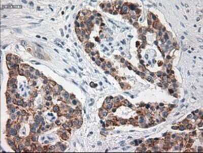 Immunohistochemistry: Cytokeratin 18 Antibody (OTI1E1) - Azide and BSA Free [NBP2-71086] - Staining of paraffin-embedded Carcinoma of Human pancreas tissue using anti-KRT18 mouse monoclonal antibody.