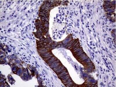 Immunohistochemistry: Cytokeratin 18 Antibody (OTI1E1) - Azide and BSA Free [NBP2-71086] - Staining of paraffin-embedded Adenocarcinoma of Human colon tissue. Heat-induced epitope retrieval by 10mM citric buffer, pH6.0, 100C for 10min.