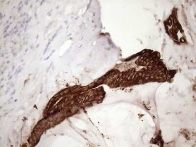 Immunohistochemistry: Cytokeratin 18 Antibody (OTI3D1) - Azide and BSA Free [NBP2-71089] - Analysis of Carcinoma of Human pancreas tissue. (Heat-induced epitope retrieval by 1mM EDTA in 10mM Tris buffer (pH8.5) at 120C for 3 min)