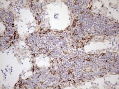 Immunohistochemistry: Cytokeratin 18 Antibody (OTI3D1) - Azide and BSA Free [NBP2-71089] - Analysis of Carcinoma of Human thyroid tissue.(Heat-induced epitope retrieval by 1mM EDTA in 10mM Tris buffer (pH8.5) at 120C for 3 min)