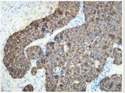 Immunohistochemistry-Paraffin: Cytokeratin 18 Antibody (R20-H) [NBP1-79072] - CK18 expression in the adenosquamous carcinoma of the human pancreas. Formalin fixed, paraffin embedded human tissue (4 um section) stained with anti-Cytokeratin 18 monospecific clonal antibody.