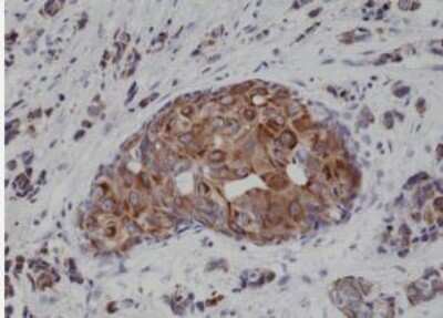 Immunohistochemistry-Paraffin: Cytokeratin 18 Antibody (RM279) [NBP2-61519] - Immunohistochemical staining of formalin fixed and paraffin embedded Human breast cancer tissue sections using NBP2-61519.