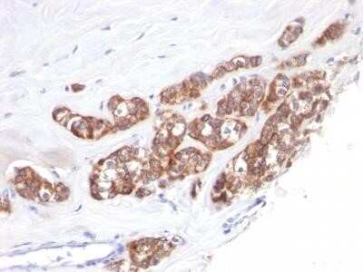 Immunohistochemistry-Paraffin: Cytokeratin 18 Antibody (SPM510) - Azide and BSA Free [NBP2-34414] - Formalin-fixed, paraffin-embedded human Breast Carcinoma stained with Cytokeratin 18 Monoclonal Antibody (SPM510).