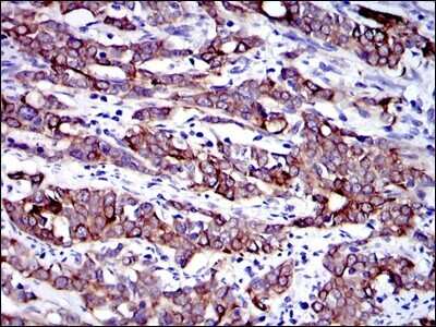 Immunohistochemistry: Cytokeratin 19 Antibody (4E8) - Azide and BSA Free [NBP2-80689] - Immunohistochemical analysis of paraffin-embedded human cervical cancer tissues using Cytokeratin 19 mouse mAb with DAB staining. Image from the standard format of this antibody.