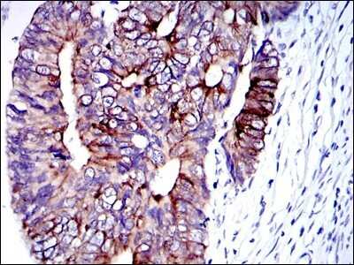 Immunohistochemistry: Cytokeratin 19 Antibody (4E8) - Azide and BSA Free [NBP2-80689] - Immunohistochemical analysis of paraffin-embedded human colon cancer tissues using Cytokeratin 19 mouse mAb with DAB staining. Image from the standard format of this antibody.