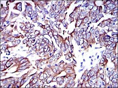 Immunohistochemistry: Cytokeratin 19 Antibody (4E8) - Azide and BSA Free [NBP2-80689] - Immunohistochemical analysis of paraffin-embedded human stomach cancer tissues using Cytokeratin 19 mouse mAb with DAB staining. Image from the standard format of this antibody.