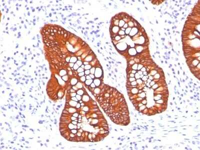 Immunohistochemistry-Paraffin: Cytokeratin 19 Antibody (A53-B/A2.26 + BA17) - Azide and BSA Free [NBP2-34548] - Formalin-fixed, paraffin-embedded human colon carcinoma stained with Cytokeratin 19 MAb (A53-B/A2.26 + BA17)