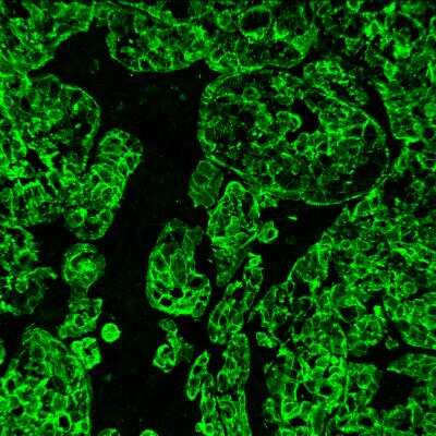 Immunohistochemistry-Frozen: Cytokeratin 19 Antibody (A53-B/A2.26 + BA17) [DyLight 405] [NBP2-34548V] - Human breast cancer tissue stained with CK19 antibody. IHC-Fr image submitted by a verified customer review.