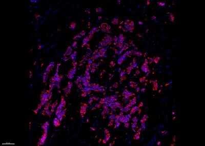 Immunohistochemistry-Frozen: Cytokeratin 19 Antibody (A53-B/A2.26) [Janelia Fluor® 549] [NBP2-33134JF549] - Breast cancer tissue stained for Cytokeratin 19 (red) and counter stained with DAPI (blue). IHC-Fr image submitted by a verified customer review.