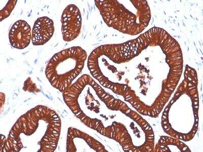 Immunohistochemistry-Paraffin: Cytokeratin 19 Antibody (BA17) - Azide and BSA Free [NBP2-34560] - Formalin-fixed, paraffin-embedded human colon stained with Cytokeratin 19 MAb (BA17)image 1 of 5previousnextclose