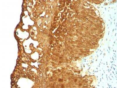 Immunohistochemistry-Paraffin: Cytokeratin 19 Antibody (KRT19/799) - Azide and BSA Free [NBP2-47945] - Human Cervical Carcinoma stained with Cytokeratin 19 Mouse Monoclonal Antibody (KRT19/799).