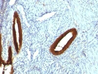 Immunohistochemistry-Paraffin: Cytokeratin 19 Antibody (KRT19/800) - Azide and BSA Free [NBP2-47946] - Human Endometrial Carcinoma stained with Cytokeratin 19 Monoclonal Antibody (KRT19/800)