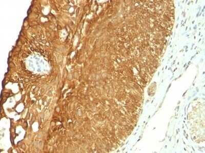 Immunohistochemistry-Paraffin: Cytokeratin 19 Antibody (KRT19/800) - Azide and BSA Free [NBP2-47946] - Human Cervical Carcinoma stained with Cytokeratin 19 Monoclonal Antibody (KRT19/800)