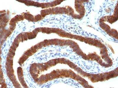 Immunohistochemistry-Paraffin: Cytokeratin 19 Antibody (Ks19.1) - Azide and BSA Free [NBP2-47947] - Human Ovarian Carcinoma stained with Cytokeratin 19 Ab (Ks19.1)