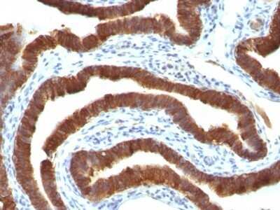Immunohistochemistry-Paraffin: Cytokeratin 19 Antibody (Ks19.1) - IHC-Prediluted [NBP2-48096] - Human Ovarian Carcinoma stained with Cytokeratin 19 Ab (Ks19.1).