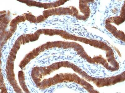 Immunohistochemistry-Paraffin: Cytokeratin 19 Antibody (Ks19.1) [NBP2-44828] - Human Ovarian Carcinoma stained with Cytokeratin 19 Ab (Ks19.1).