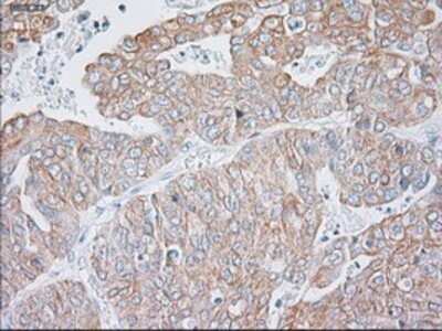 Immunohistochemistry: Cytokeratin 19 Antibody (OTI3F8) - Azide and BSA Free [NBP2-71092] - Staining of paraffin-embedded Adenocarcinoma of endometrium tissue using anti-Cytokeratin 19 mouse monoclonal antibody.