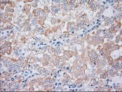 Immunohistochemistry: Cytokeratin 19 Antibody (OTI3F8) - Azide and BSA Free [NBP2-71092] - Staining of paraffin-embedded Carcinoma of kidney tissue using anti-Cytokeratin 19 mouse monoclonal antibody.