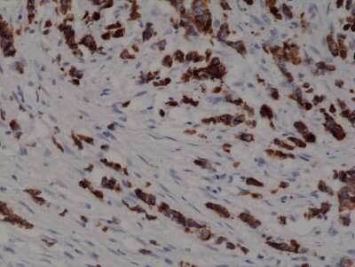 Immunohistochemistry: Cytokeratin 19 Antibody (RM364) [NBP2-77426] - Immunohistochemical staining of formalin fixed and paraffin embedded human breast cancer tissue section using NBP2-77426.