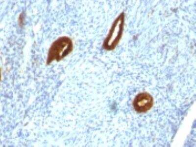 Immunohistochemistry-Paraffin: Cytokeratin 19 Antibody (SPM266) [NBP2-34357] - Formalin-fixed, paraffin-embedded human Endometrial Carcinoma stained with cytokeratin 19 Monoclonal Antibody (SPM266).