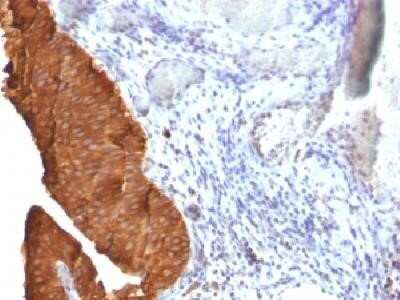 Immunohistochemistry-Paraffin: Cytokeratin 19 Antibody (SPM561) - Azide and BSA Free [NBP2-34426] - Formalin-fixed, paraffin-embedded human Bladder carcinoma stained with cytokeratin 19 Monoclonal Antibody (SPM561).