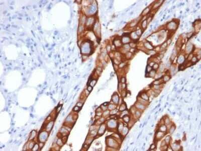 Immunohistochemistry-Paraffin: Cytokeratin 20 Antibody (KRT20/1991) [NBP3-08406] - Formalin-fixed, paraffin-embedded human Colon Carcinoma stained with Cytokeratin 20 Mouse Monoclonal Antibody (KRT20/1991).