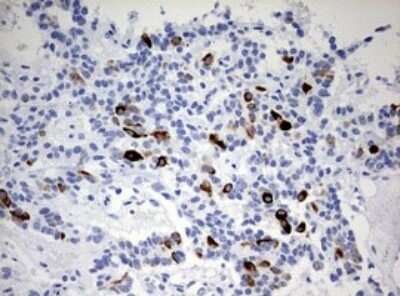 Immunohistochemistry: Cytokeratin 20 Antibody (OTI3G1) - Azide and BSA Free [NBP2-71962] - Analysis of Carcinoma of Human pancreas tissue. (Heat-induced epitope retrieval by 10mM citric buffer, pH6.0, 120C for 3min)
