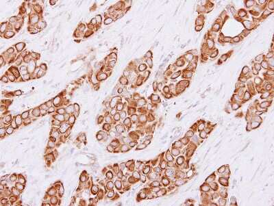 Immunohistochemistry-Paraffin: Cytokeratin 4 Antibody [NBP1-33592] - Paraffin-embedded Breast ca, using antibody at 1:250 dilution.