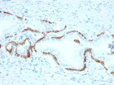 Immunohistochemistry-Paraffin: Cytokeratin 5/6 Antibody (KRT5.6/2438) [NBP3-07628] - Formalin-fixed, paraffin-embedded human Prostate Carcinoma stained with Cytokeratin 5/6 Mouse Monoclonal Antibody (KRT5.6/2438).
