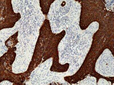 Immunohistochemistry-Paraffin: Cytokeratin 5/6 Antibody (RM341) [NBP2-77439] - Immunohistochemical staining of formalin fixed and paraffin embedded human Lung Squamous Cell Carcinoma tissue section using anti-CK-5/CK-6 rabbit monoclonal antibody (Clone RM341) at a 1:1000 dilution.