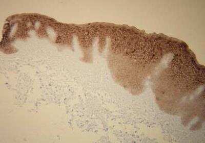 Immunohistochemistry-Paraffin: Cytokeratin 5/6 Antibody (T16-K) [NBP2-36738] - Cytokeratin 5/6 expression in the epidermis of the skin.