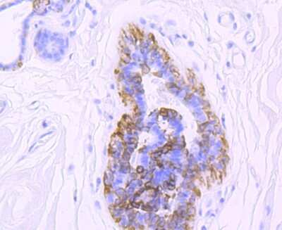 Immunohistochemistry-Paraffin: Cytokeratin 5/75 Antibody (SY88-19) [NBP2-67027] - Analysis of paraffin-embedded human brest cancer tissue using anti-Cytokeratin 5 antibody. Counter stained with hematoxylin.