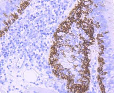 Immunohistochemistry-Paraffin: Cytokeratin 5/75 Antibody (SY88-19) [NBP2-67027] - Analysis of paraffin-embedded human lung cancer tissue using anti-Cytokeratin 5 antibody. Counter stained with hematoxylin.