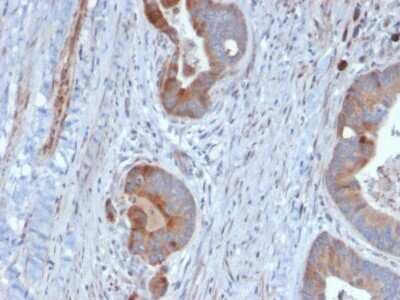 Immunohistochemistry-Paraffin: Cytokeratin 6 Antibody (KRT6B/2116) - Azide and BSA Free [NBP3-08612] - Formalin-fixed, paraffin-embedded human prostate stained with Cytokeratin 6 Monoclonal Antibody (KRT6B/2116).